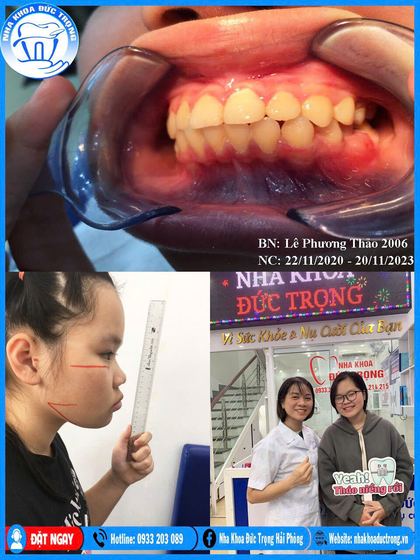 Ảnh ghép ca niềng răng số 1: răng trước, trong và sau khi niềng, kèm ảnh chân dung khách