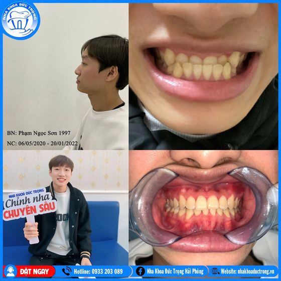 Ảnh ghép ca niềng răng số 2: răng trước, trong và sau khi niềng, kèm ảnh chân dung khách