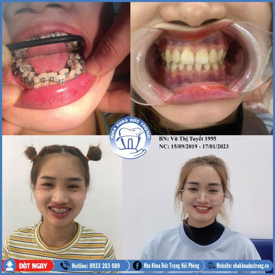 Ảnh ghép ca niềng răng số 3: răng trước, trong và sau khi niềng, kèm ảnh chân dung khách