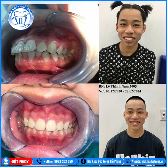 Ảnh ghép ca niềng răng số 4: răng trước, trong và sau khi niềng, kèm ảnh chân dung khách