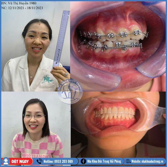 Ảnh ghép ca niềng răng số 5: răng trước, trong và sau khi niềng, kèm ảnh chân dung khách