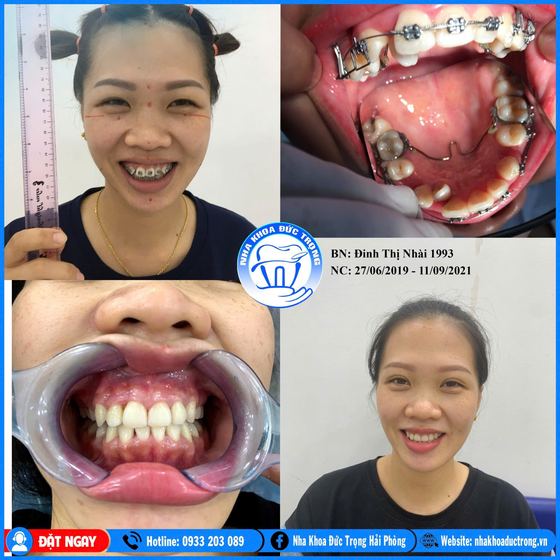 Ảnh ghép ca niềng răng số 6: răng trước, trong và sau khi niềng, kèm ảnh chân dung khách