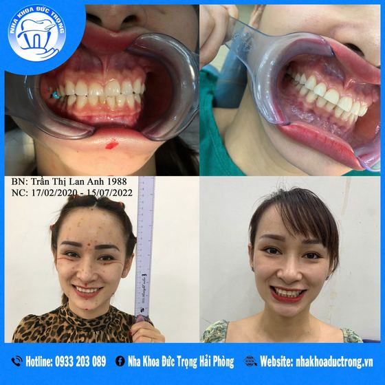 Ảnh ghép ca niềng răng số 7: răng trước, trong và sau khi niềng, kèm ảnh chân dung khách
