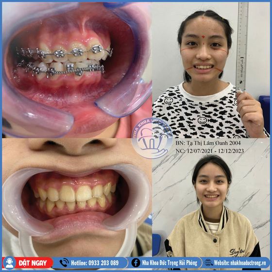 Ảnh ghép ca niềng răng số 8: răng trước, trong và sau khi niềng, kèm ảnh chân dung khách