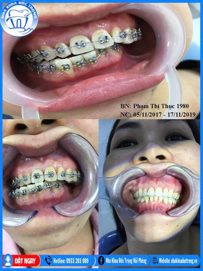 Ảnh ghép ca niềng răng số 9: răng trước, trong và sau khi niềng, kèm ảnh chân dung khách