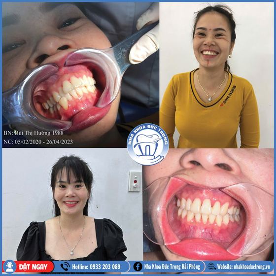 Ảnh ghép ca niềng răng số 10: răng trước, trong và sau khi niềng, kèm ảnh chân dung khách
