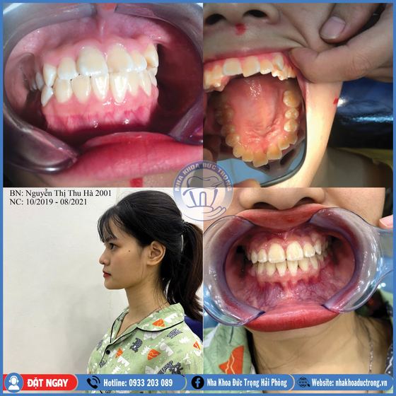 Ảnh ghép ca niềng răng số 11: răng trước, trong và sau khi niềng, kèm ảnh chân dung khách