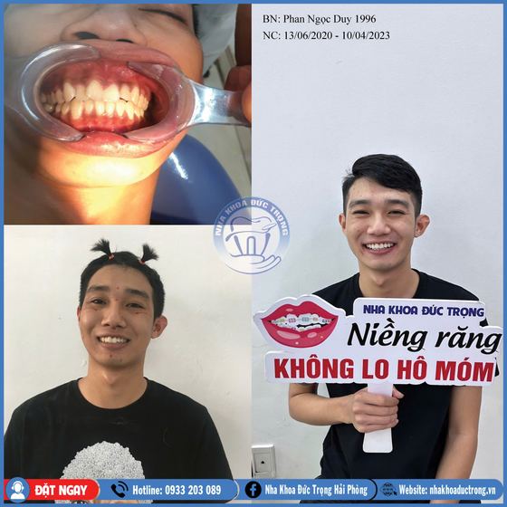 Ảnh ghép ca niềng răng số 12: răng trước, trong và sau khi niềng, kèm ảnh chân dung khách