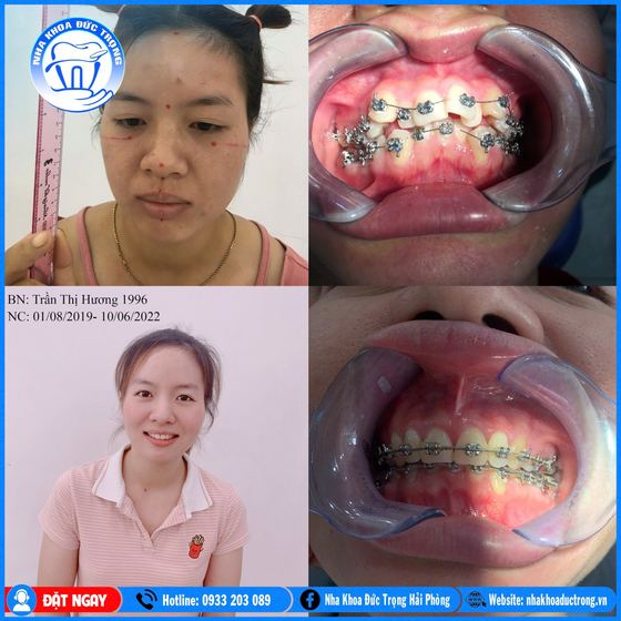 Ảnh ghép ca niềng răng số 13: răng trước, trong và sau khi niềng, kèm ảnh chân dung khách