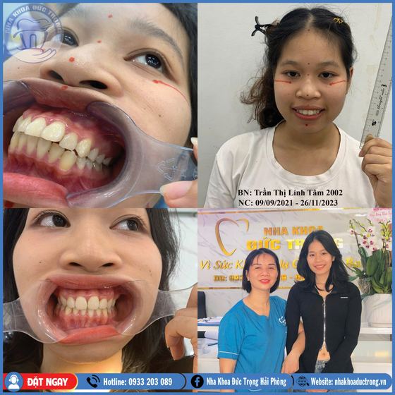 Ảnh ghép ca niềng răng số 14: răng trước, trong và sau khi niềng, kèm ảnh chân dung khách