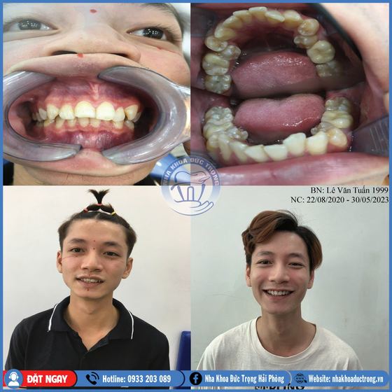 Ảnh ghép ca niềng răng số 15: răng trước, trong và sau khi niềng, kèm ảnh chân dung khách