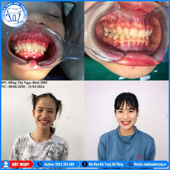 Ảnh ghép ca niềng răng số 16: răng trước, trong và sau khi niềng, kèm ảnh chân dung khách