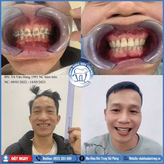 Ảnh ghép ca niềng răng số 17: răng trước, trong và sau khi niềng, kèm ảnh chân dung khách