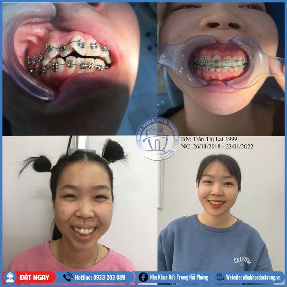 Ảnh ghép ca niềng răng số 18: răng trước, trong và sau khi niềng, kèm ảnh chân dung khách