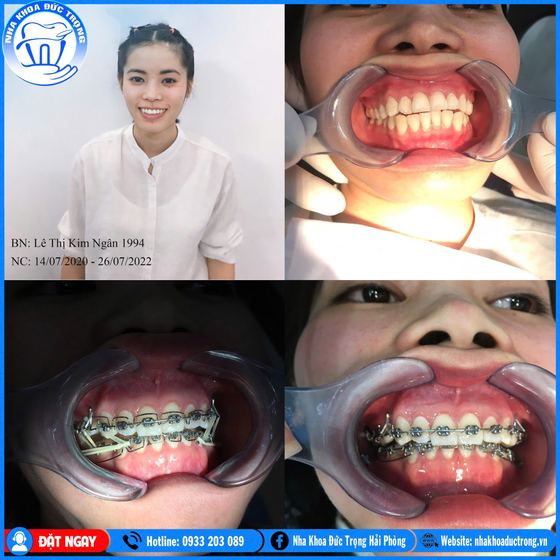 Ảnh ghép ca niềng răng số 19: răng trước, trong và sau khi niềng, kèm ảnh chân dung khách