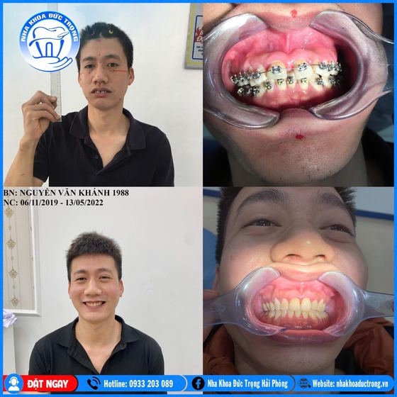 Ảnh ghép ca niềng răng số 20: răng trước, trong và sau khi niềng, kèm ảnh chân dung khách