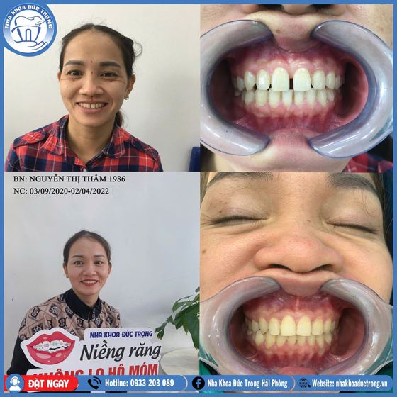 Ảnh ghép ca niềng răng số 21: răng trước, trong và sau khi niềng, kèm ảnh chân dung khách