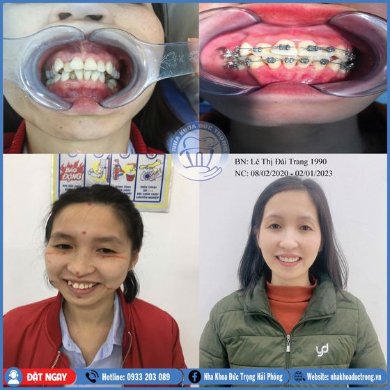 Ảnh ghép ca niềng răng số 22: răng trước, trong và sau khi niềng, kèm ảnh chân dung khách