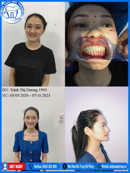 Ảnh ghép ca niềng răng số 23: răng trước, trong và sau khi niềng, kèm ảnh chân dung khách