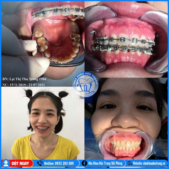 Ảnh ghép ca niềng răng số 24: răng trước, trong và sau khi niềng, kèm ảnh chân dung khách