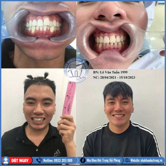 Ảnh ghép ca niềng răng số 25: răng trước, trong và sau khi niềng, kèm ảnh chân dung khách