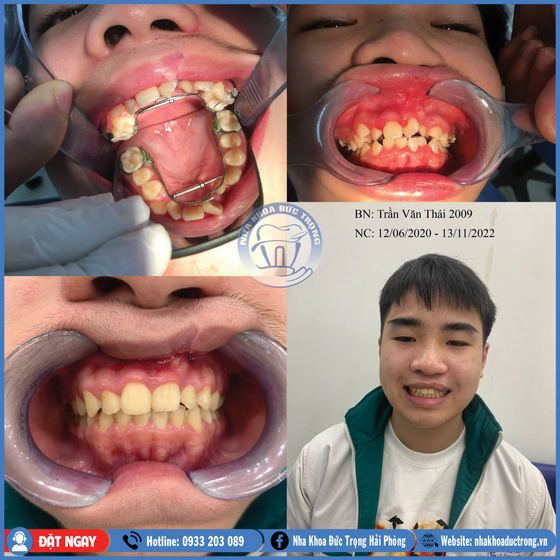 Ảnh ghép ca niềng răng số 26: răng trước, trong và sau khi niềng, kèm ảnh chân dung khách