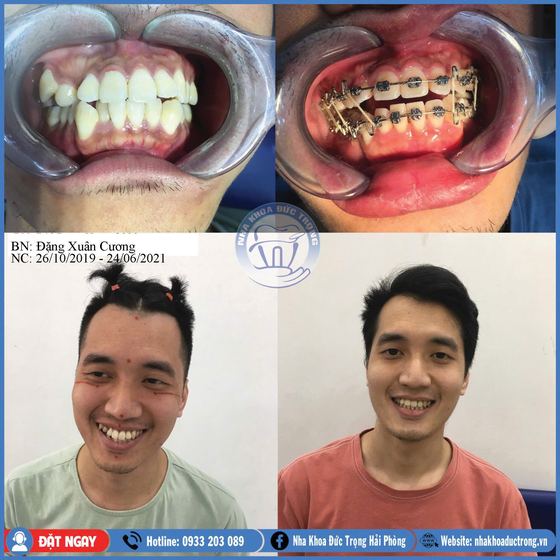 Ảnh ghép ca niềng răng số 27: răng trước, trong và sau khi niềng, kèm ảnh chân dung khách