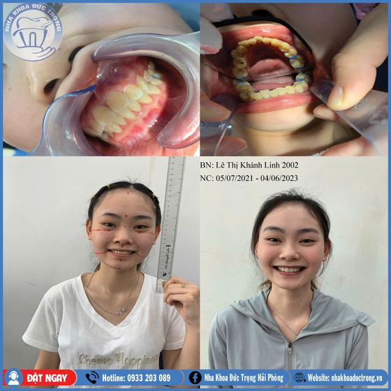 Ảnh ghép ca niềng răng số 28: răng trước, trong và sau khi niềng, kèm ảnh chân dung khách