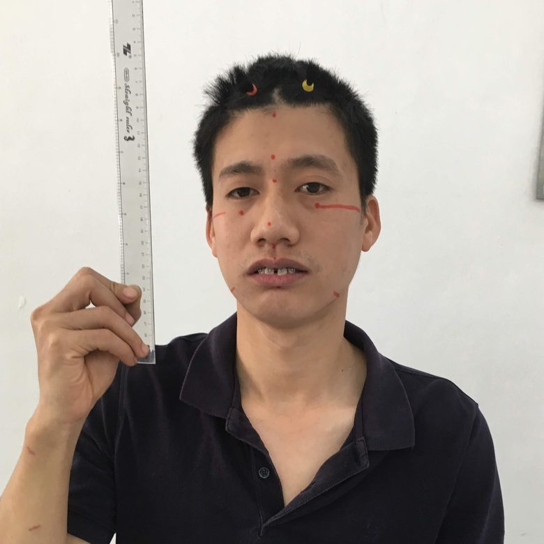 Khách hàng nam trước khi niềng răng, cầm thước đo, trên mặt có điểm đánh dấu của bác sĩ
