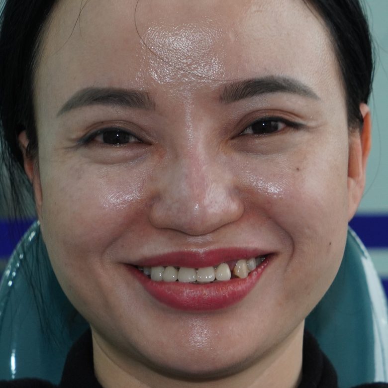 Khách hàng nữ trước khi bọc răng sứ: răng cửa mòn, thưa và lệch màu