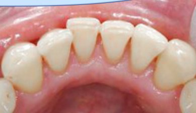 Mặt trong răng sau khi lấy sạch cao răng