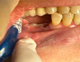 Hàm răng bị mất răng trước khi cấy implant