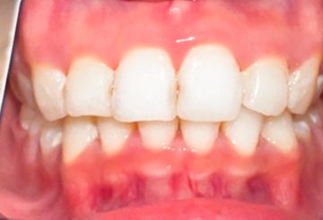 Răng khách hàng sau khi tháo mắc cài