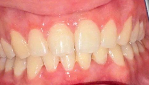 Răng chị Hồng Nhung sau khi tháo mắc cài