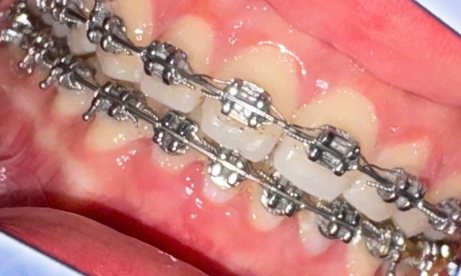 Răng chị Hồng Nhung khi đang niềng