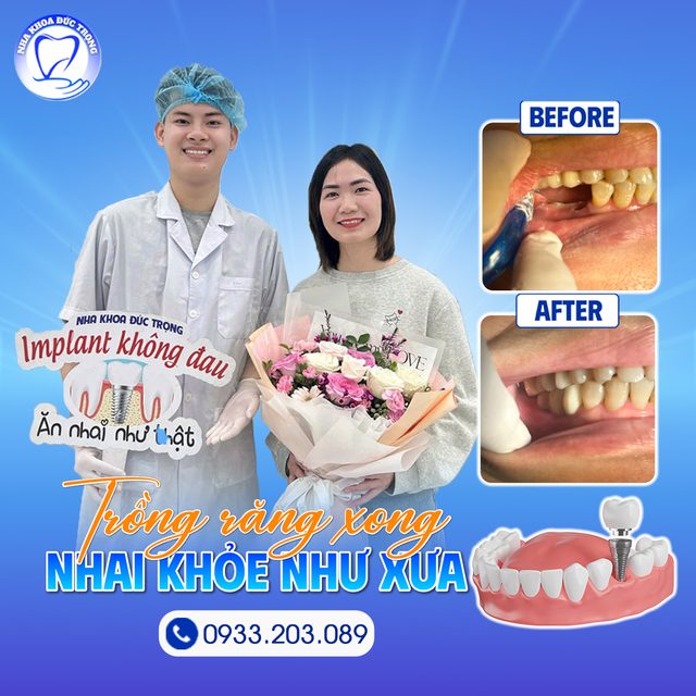Bài đăng về khách hàng trồng răng implant, kèm ảnh trước và sau
