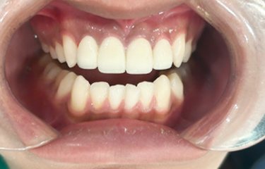 Hàm răng sau khi bọc sứ, đều màu