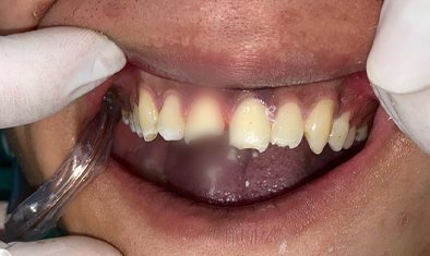 Răng cửa không đều màu trước khi bọc sứ