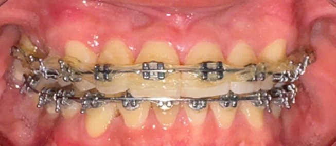 Hàm răng chị Thủy khi còn đeo mắc cài