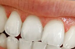 Răng cửa sau khi tẩy trắng
