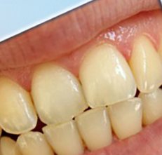 Răng cửa màu vàng ngà trước khi tẩy trắng