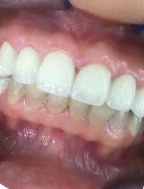 Răng trắng sáng sau khi tẩy trắng