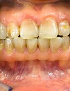 Răng ố vàng trước khi tẩy trắng