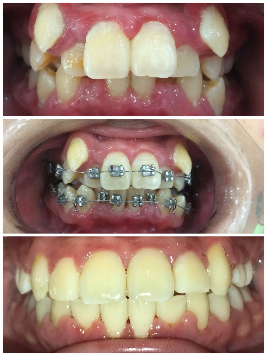 Kiến thức về dịch vụ chỉnh nha - niềng răng tại Thủy Nguyên Hải Phòng