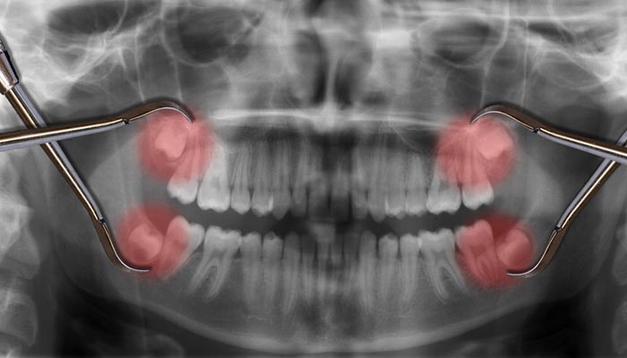 NHỔ RĂNG KHÔN CÓ ĐAU KHÔNG? Nha khoa uy tín tại Thủy Nguyên