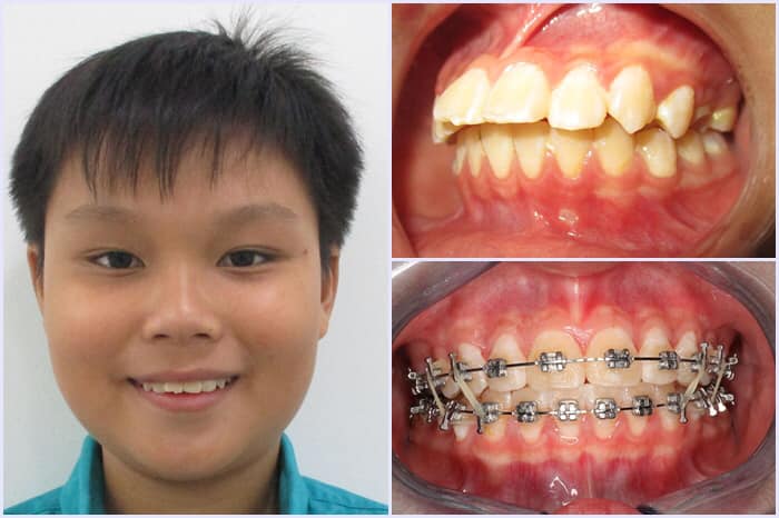Bí quyết để rút ngắn thời gian niềng răng là gì ?