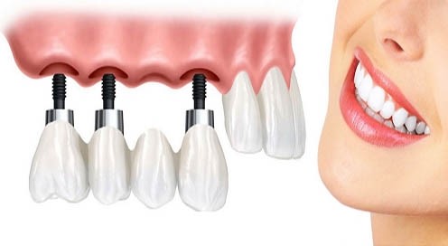 Trồng răng implant sử dụng được bao lâu ?