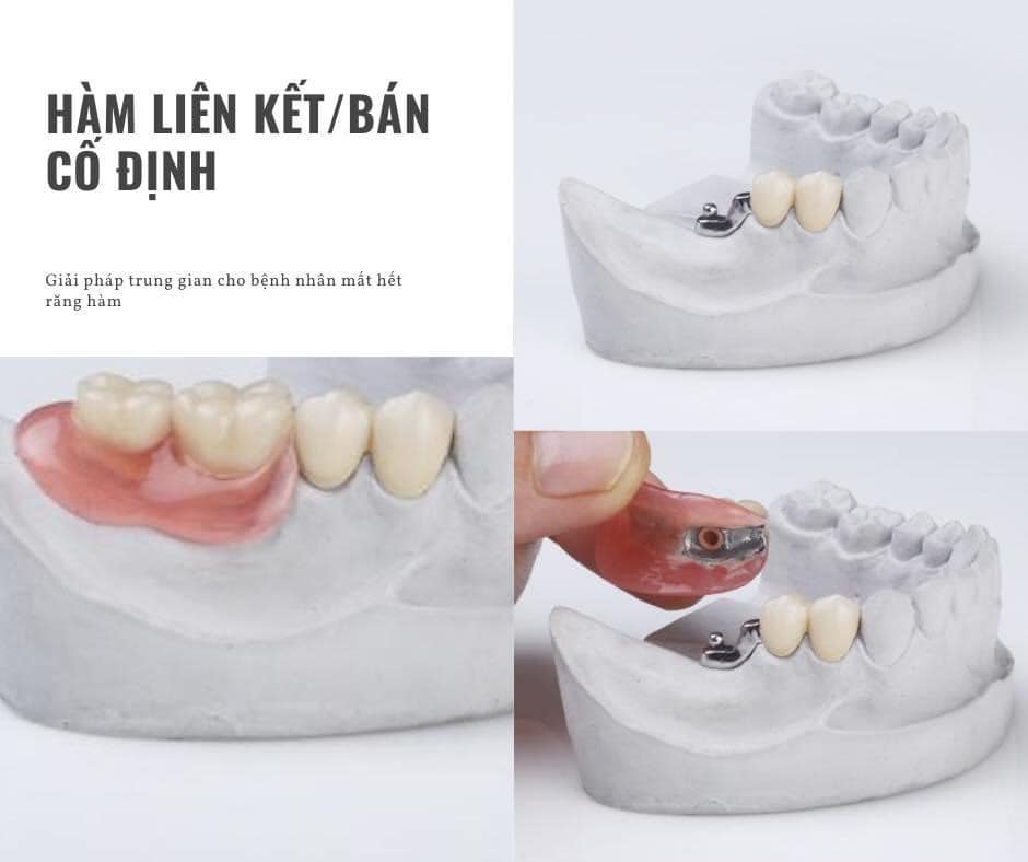 Hàm Khung liên kết - giải pháp trung gian cho bệnh nhân mất hết răng hàm!