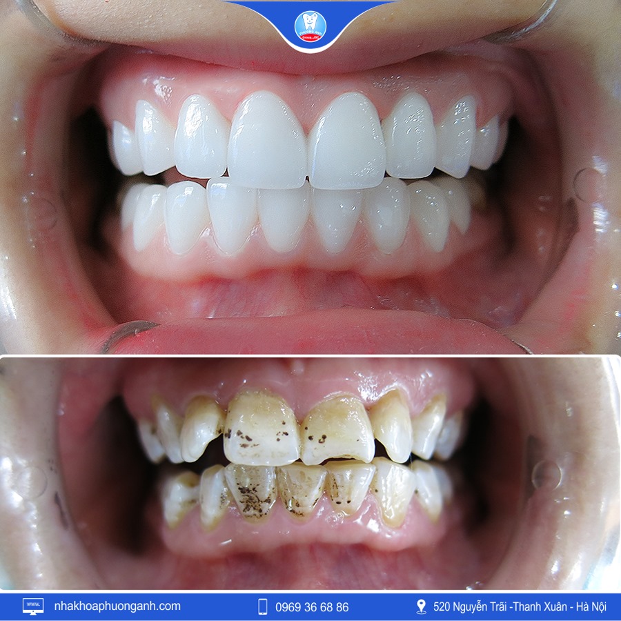 Bọc răng sứ thẩm mỹ là gì? làm răng sứ ở núi Đèo Thủy Nguyên