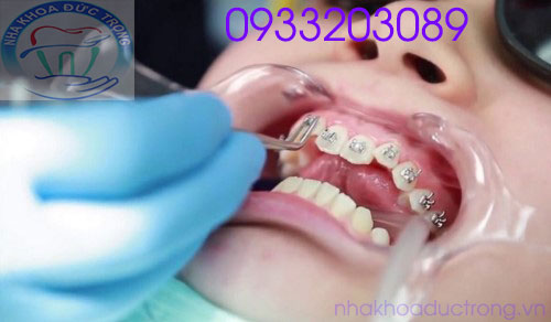 Niềng răng có đau không? Niềng răng tại Núi Đèo Thủy Nguyên